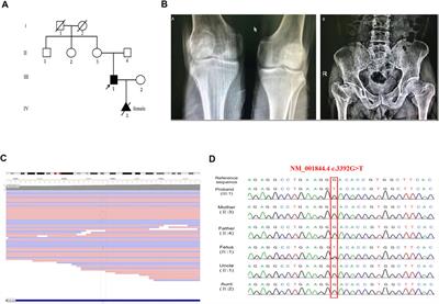 A Novel Mutation c.3392G>T of COL2A1 Causes Spondyloepiphyseal Dysplasia Congenital by Affecting Pre-mRNA Splicing